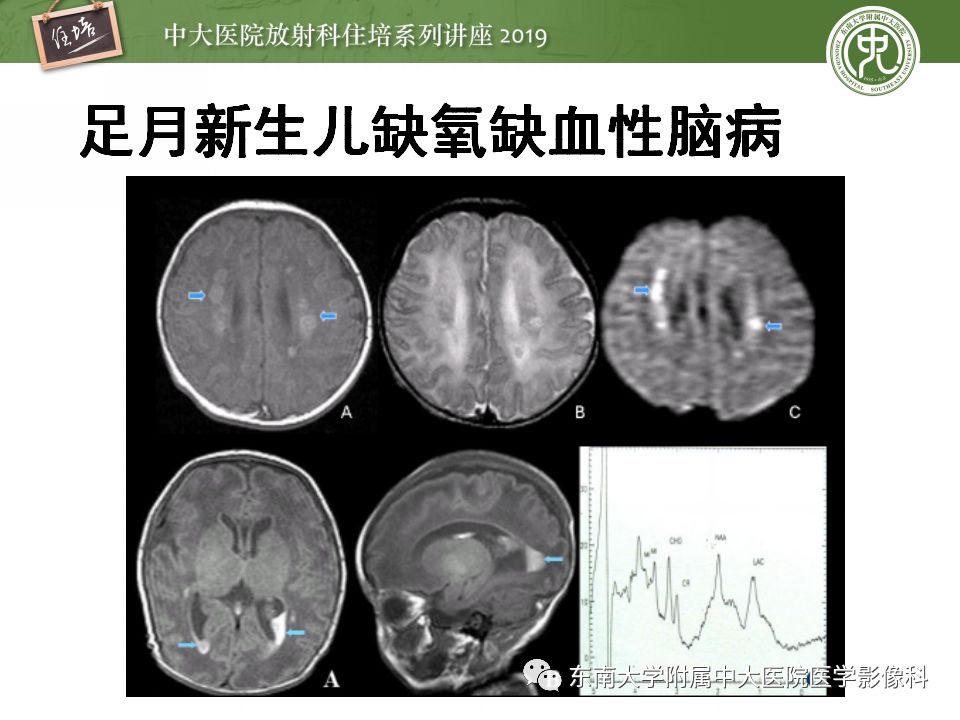 【PPT】小儿脑发育的MRI表现
