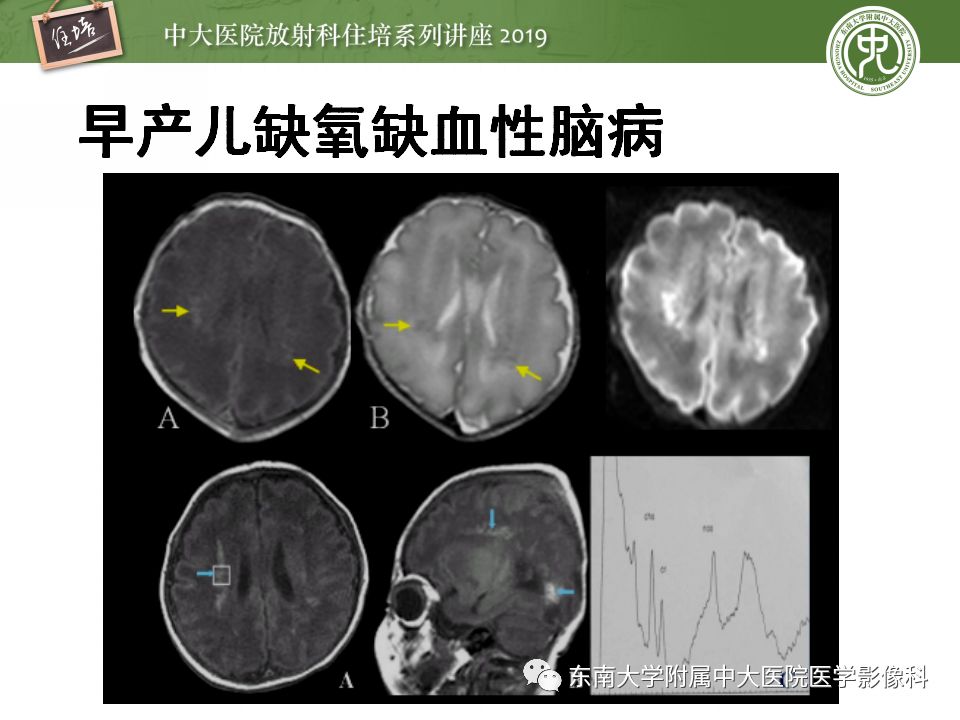 【PPT】小儿脑发育的MRI表现