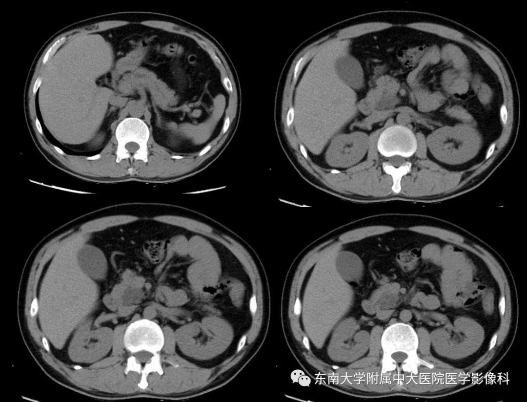 【病例】胰腺导管内乳头状瘤1例CT