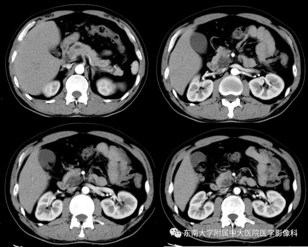 【病例】胰腺导管内乳头状瘤1例CT