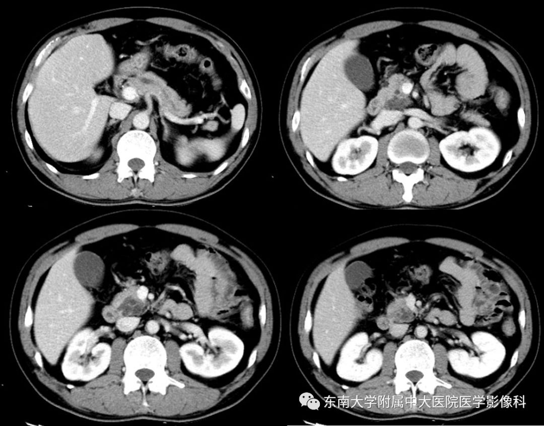 【病例】胰腺导管内乳头状瘤1例CT