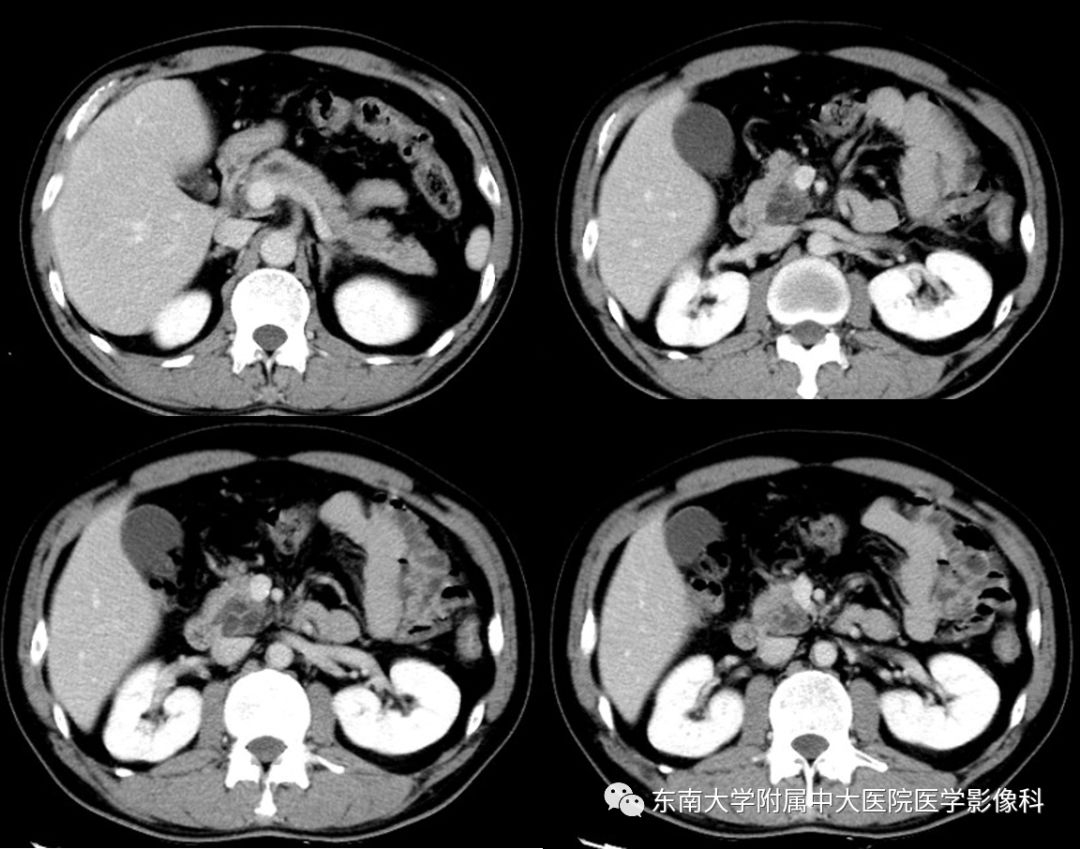 【病例】胰腺导管内乳头状瘤1例CT