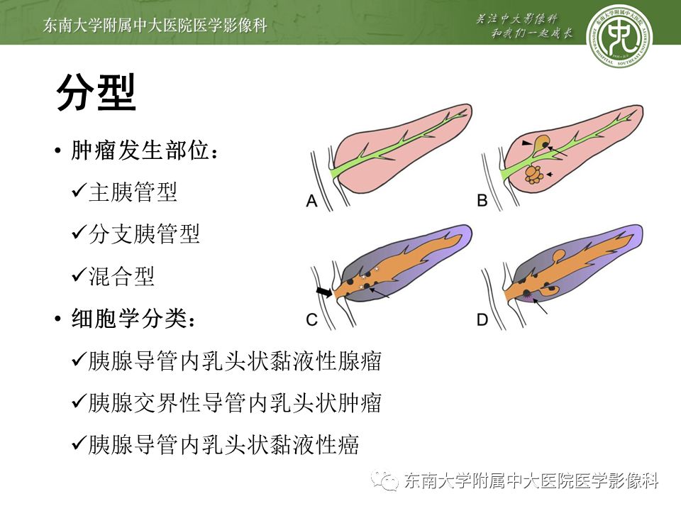 【病例】胰腺导管内乳头状瘤1例CT
