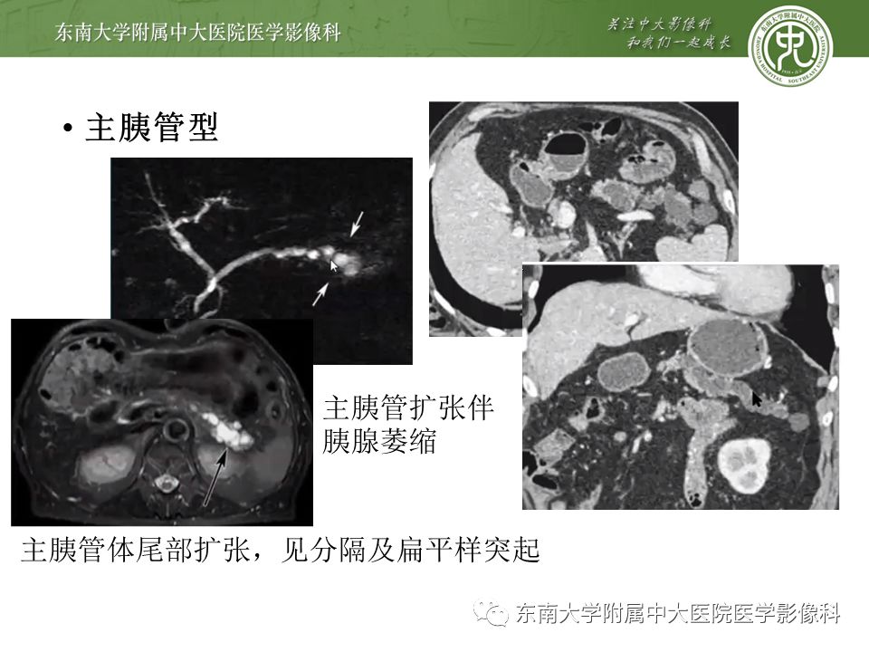 【病例】胰腺导管内乳头状瘤1例CT