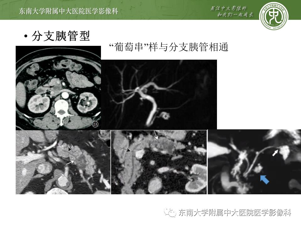 【病例】胰腺导管内乳头状瘤1例CT