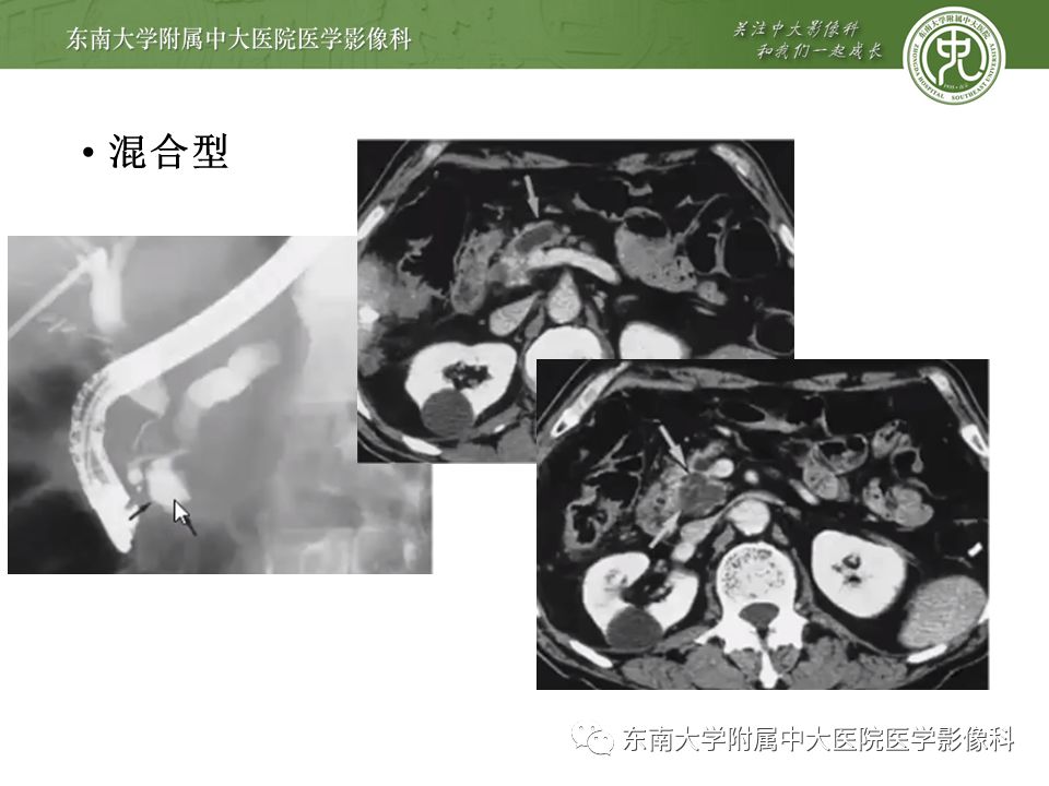 【病例】胰腺导管内乳头状瘤1例CT