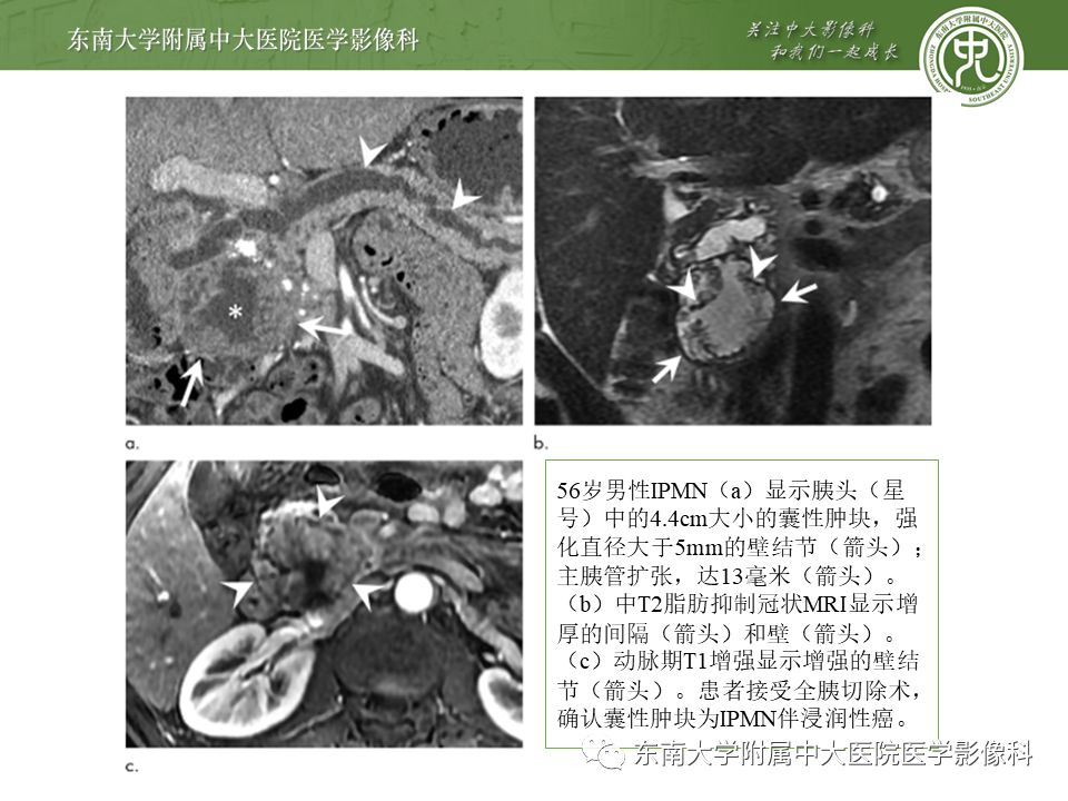 【病例】胰腺导管内乳头状瘤1例CT