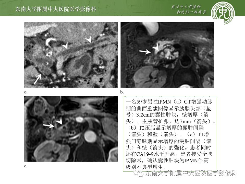 【病例】胰腺导管内乳头状瘤1例CT