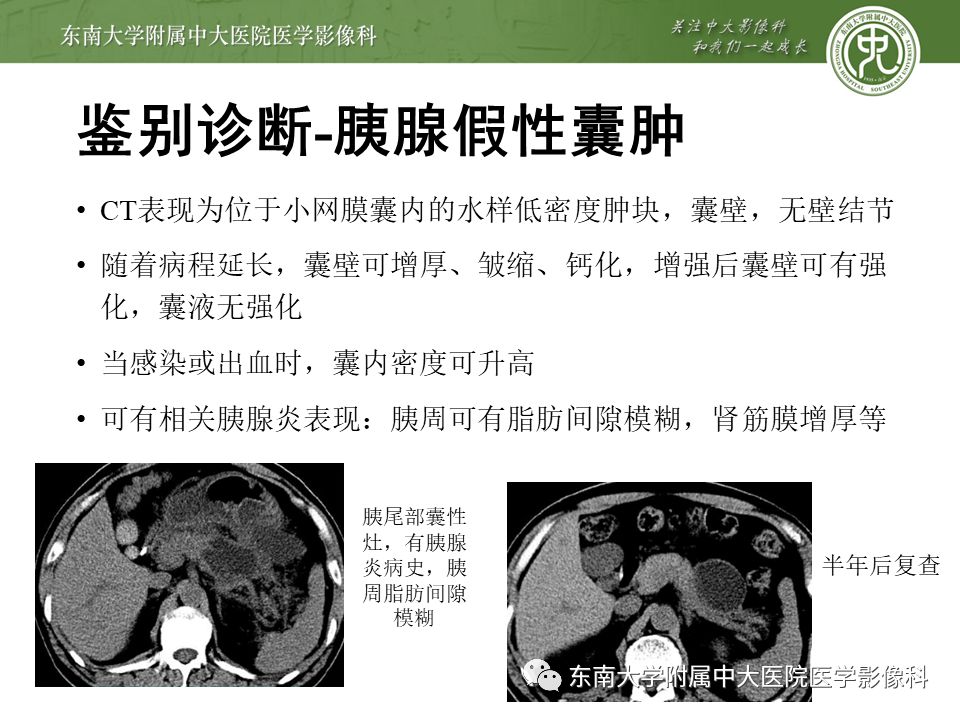 【病例】胰腺导管内乳头状瘤1例CT