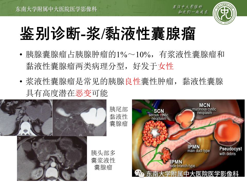 【病例】胰腺导管内乳头状瘤1例CT