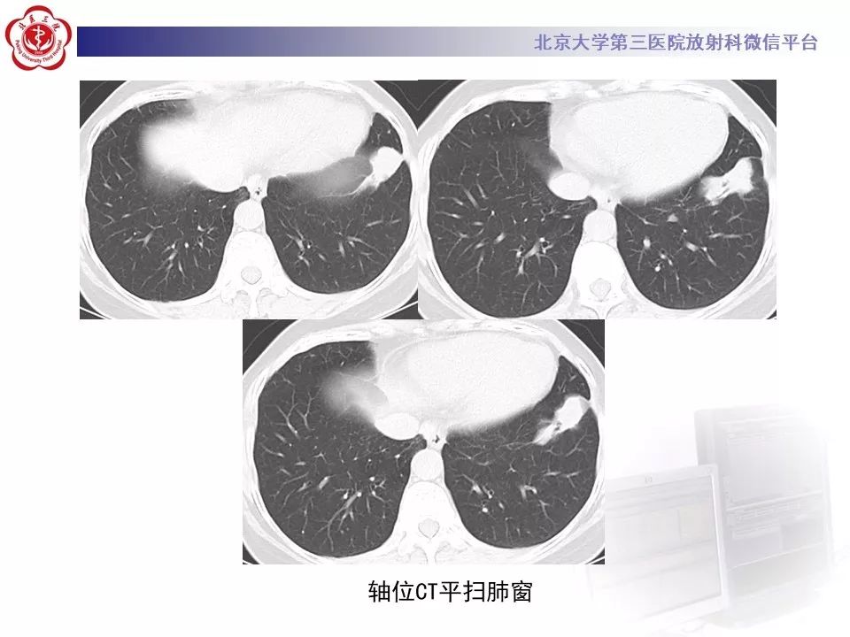 【病例】肺侵袭性粘液腺癌1例CT