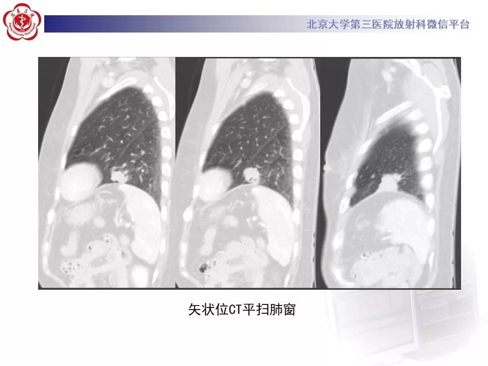 【病例】肺侵袭性粘液腺癌1例CT