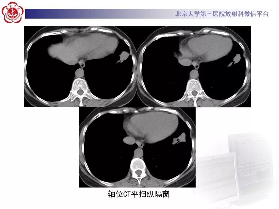 【病例】肺侵袭性粘液腺癌1例CT