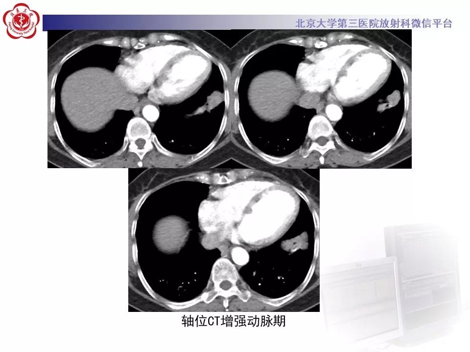 【病例】肺侵袭性粘液腺癌1例CT