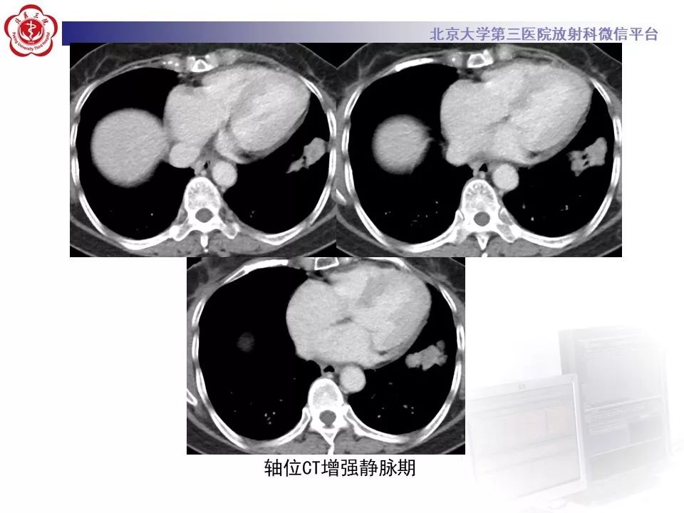 【病例】肺侵袭性粘液腺癌1例CT
