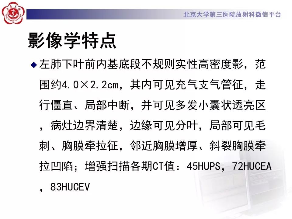 【病例】肺侵袭性粘液腺癌1例CT