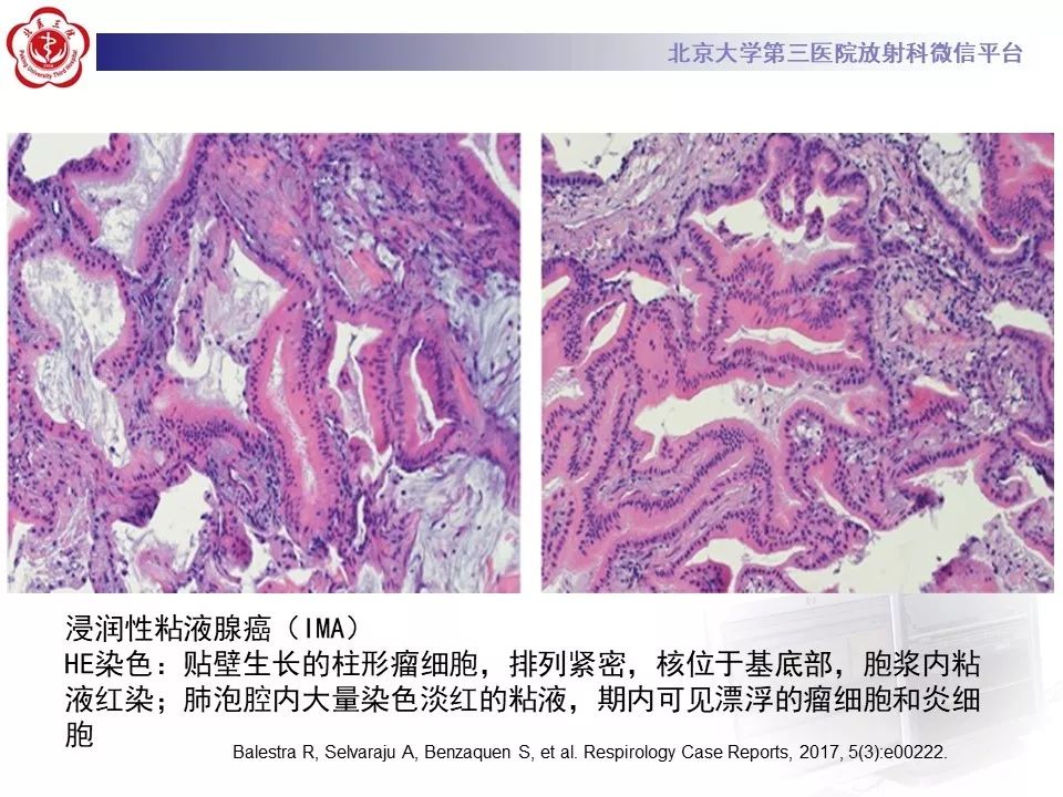 【病例】肺侵袭性粘液腺癌1例CT