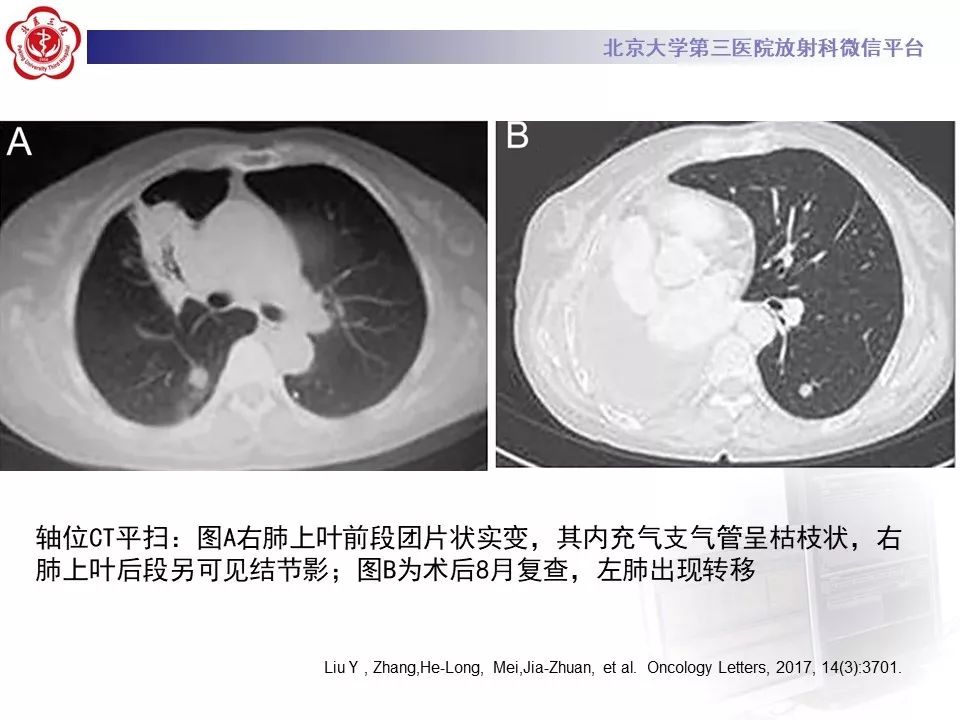 【病例】肺侵袭性粘液腺癌1例CT