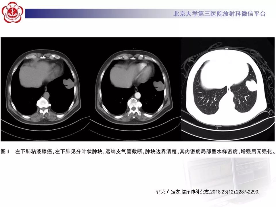 【病例】肺侵袭性粘液腺癌1例CT