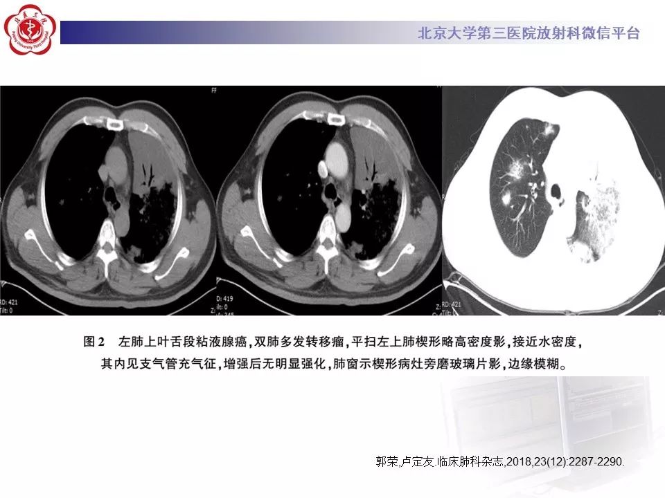 【病例】肺侵袭性粘液腺癌1例CT
