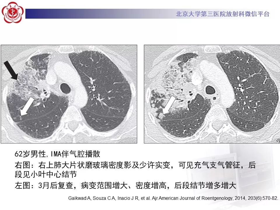 【病例】肺侵袭性粘液腺癌1例CT