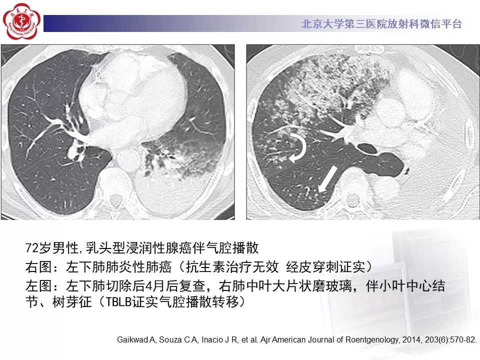 【病例】肺侵袭性粘液腺癌1例CT