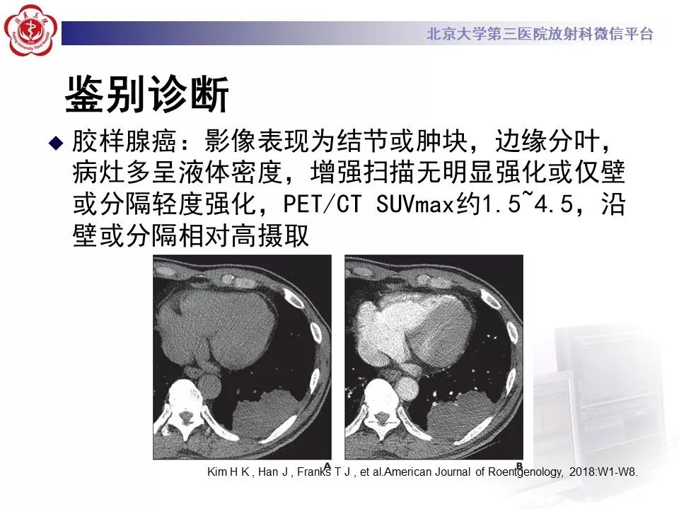 【病例】肺侵袭性粘液腺癌1例CT