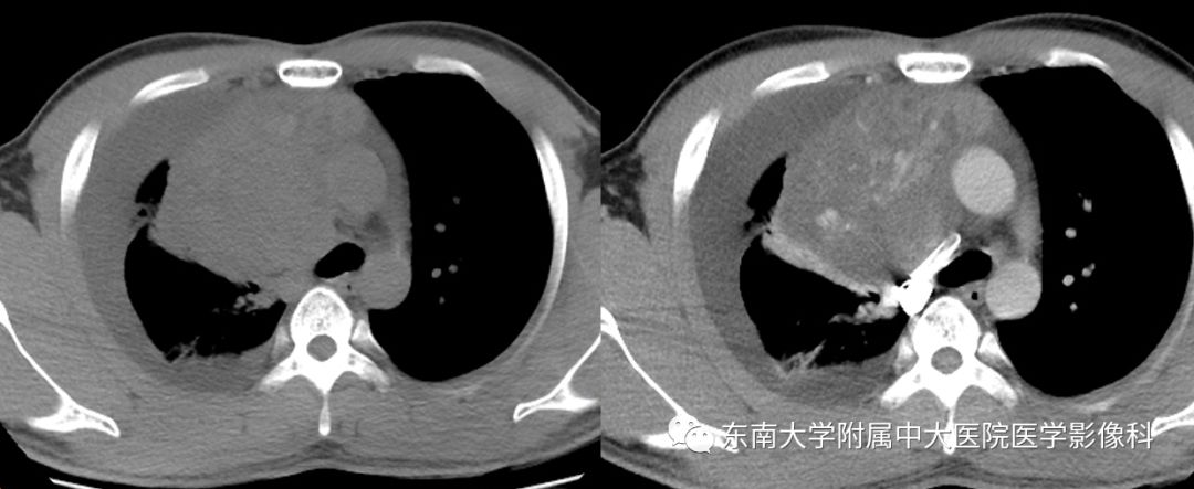 【病例】纵隔生殖细胞肿瘤1例CT