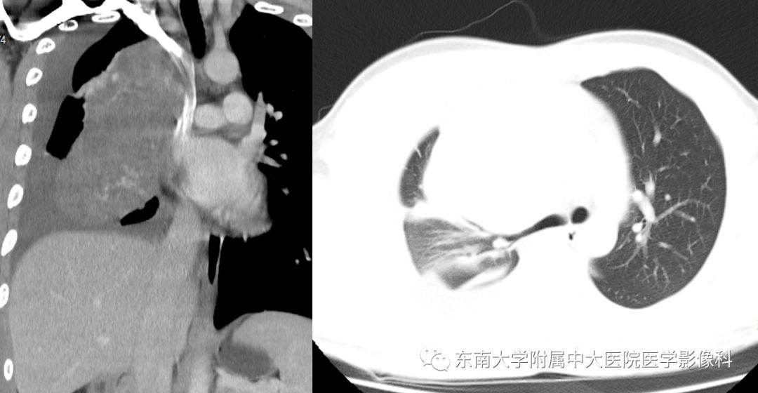 【病例】纵隔生殖细胞肿瘤1例CT