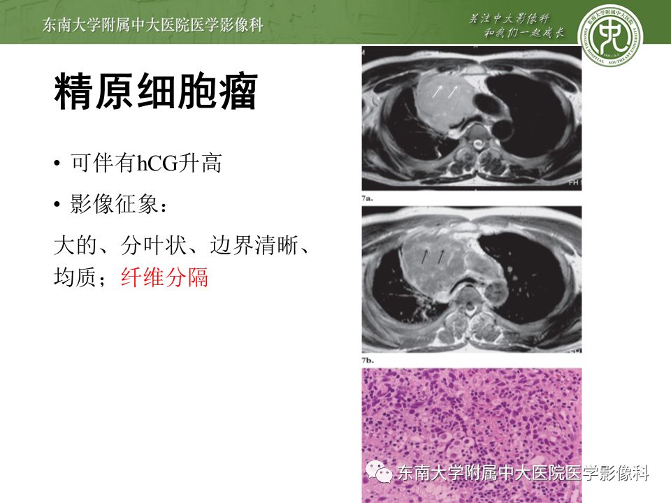 【病例】纵隔生殖细胞肿瘤1例CT