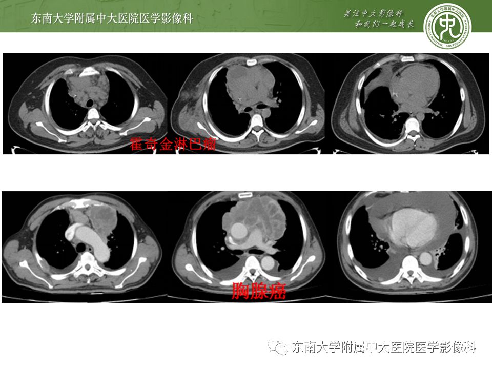【病例】纵隔生殖细胞肿瘤1例CT
