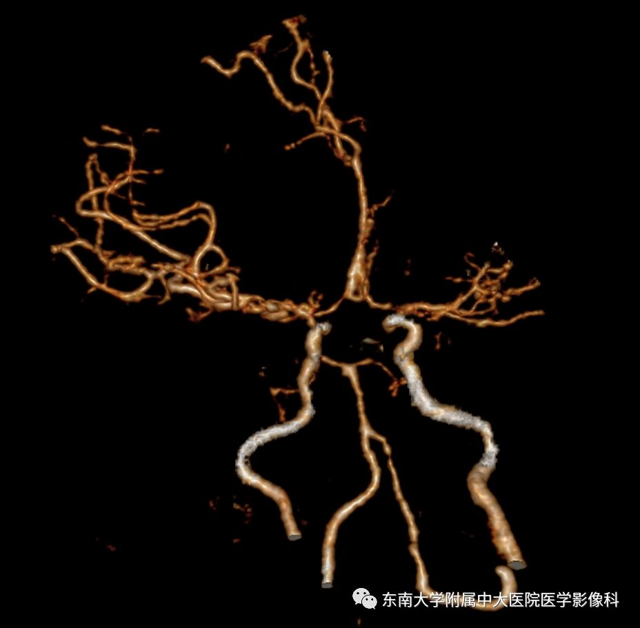 【病例】可逆性脑血管收缩综合征1例CT及MR
