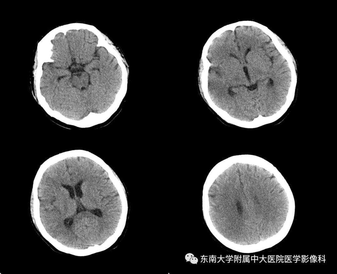 【病例】可逆性脑血管收缩综合征1例CT及MR