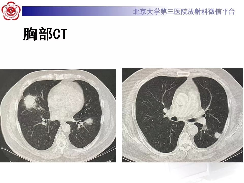 【病例】肺隐球菌病1例CT影像