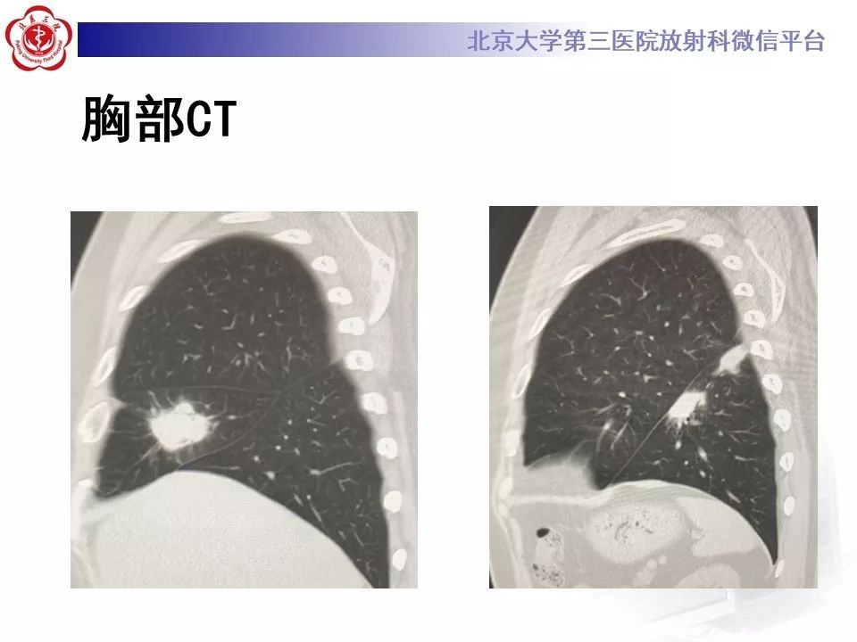【病例】肺隐球菌病1例CT影像