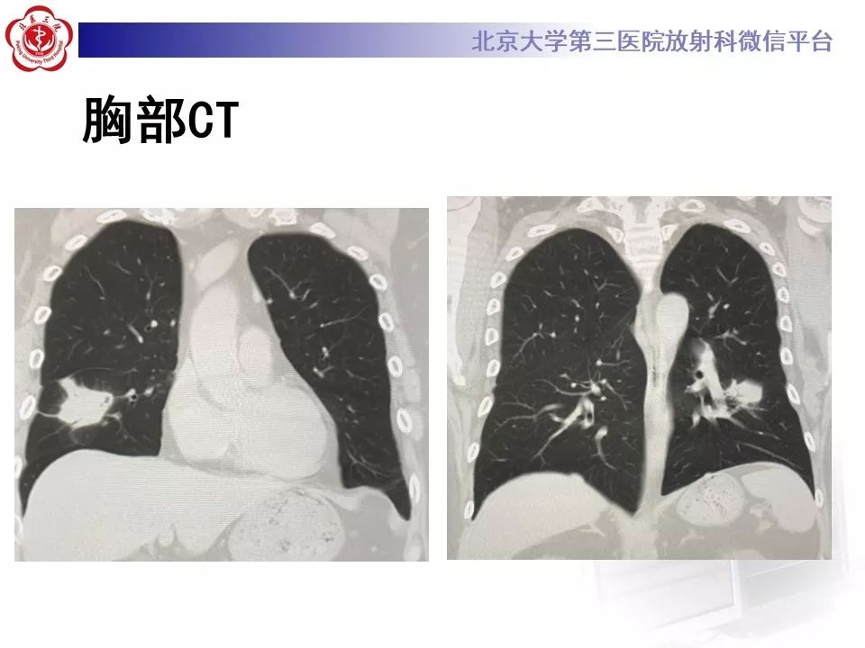 【病例】肺隐球菌病1例CT影像