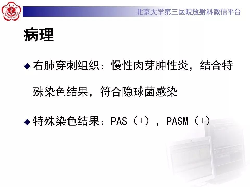 【病例】肺隐球菌病1例CT影像