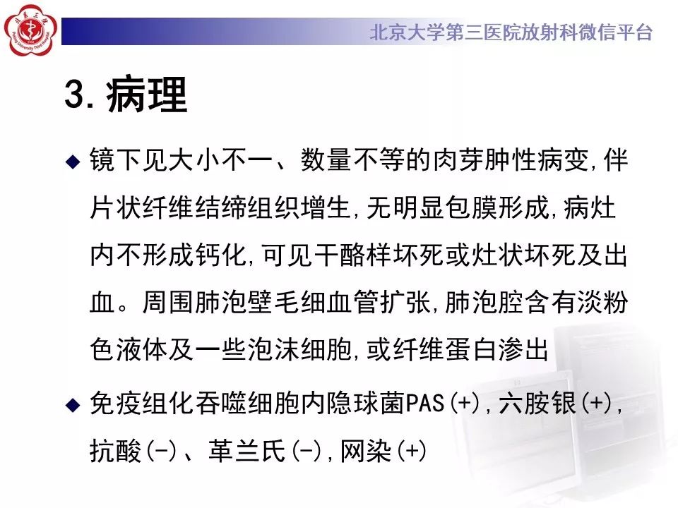 【病例】肺隐球菌病1例CT影像