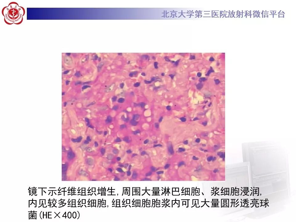 【病例】肺隐球菌病1例CT影像