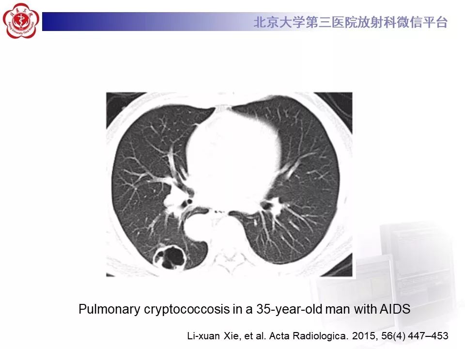 【病例】肺隐球菌病1例CT影像