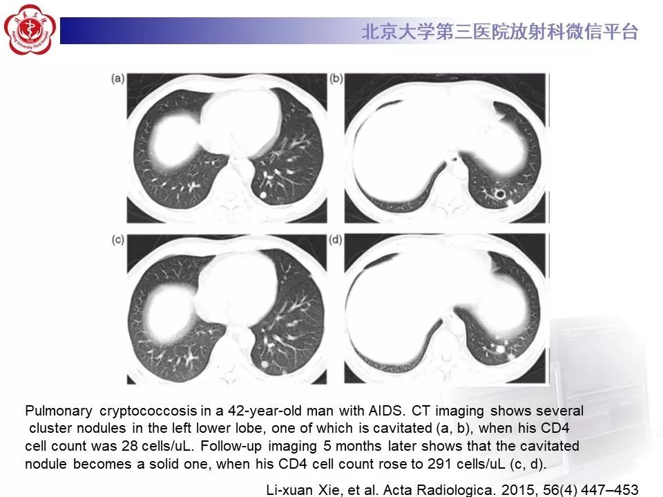 【病例】肺隐球菌病1例CT影像