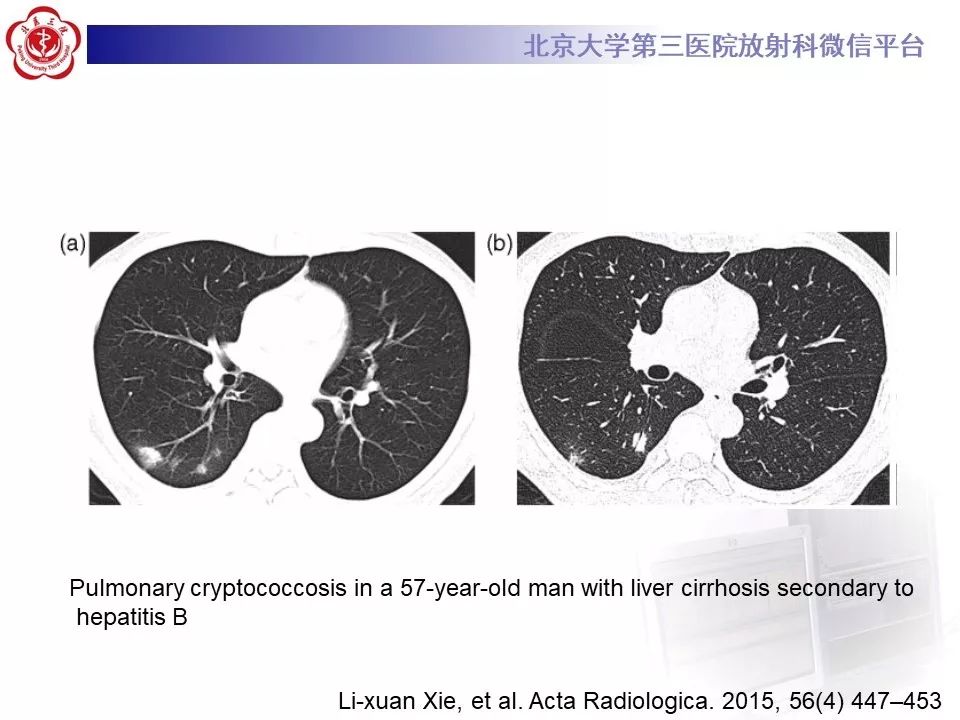 【病例】肺隐球菌病1例CT影像