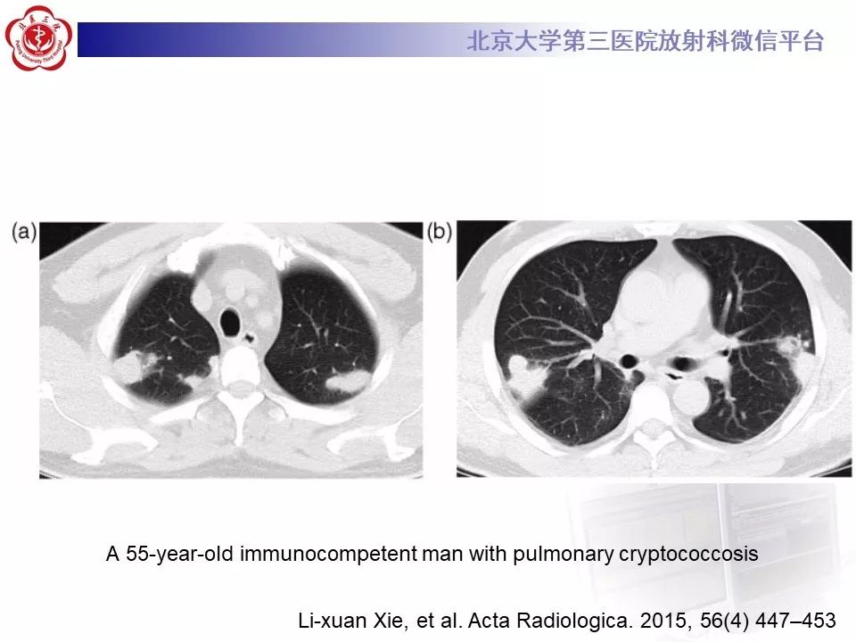 【病例】肺隐球菌病1例CT影像
