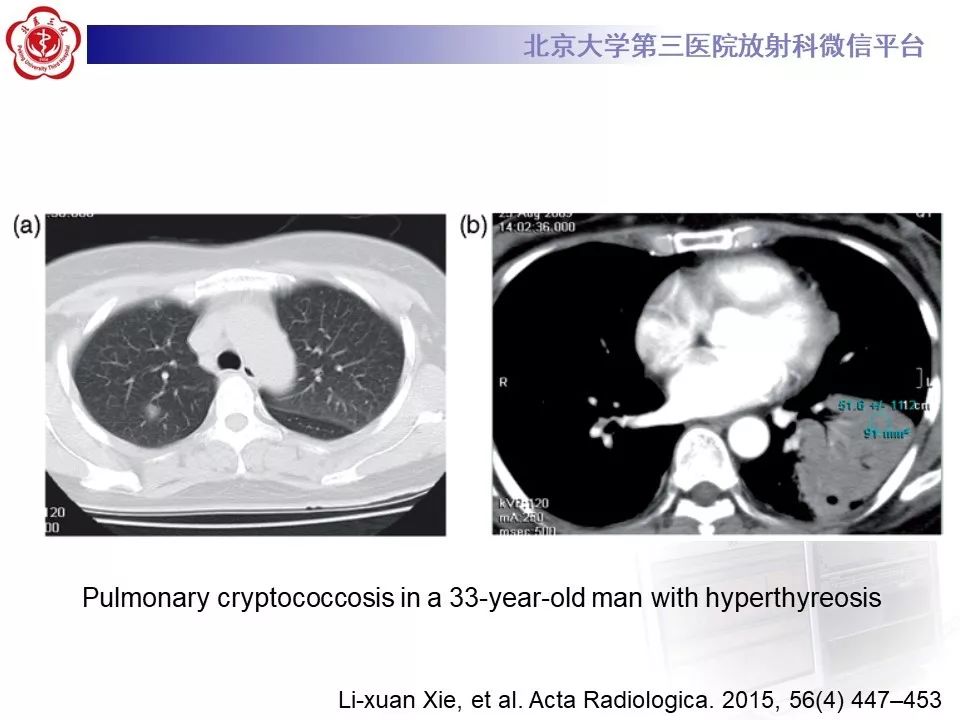 【病例】肺隐球菌病1例CT影像