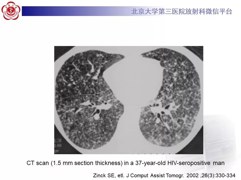 【病例】肺隐球菌病1例CT影像