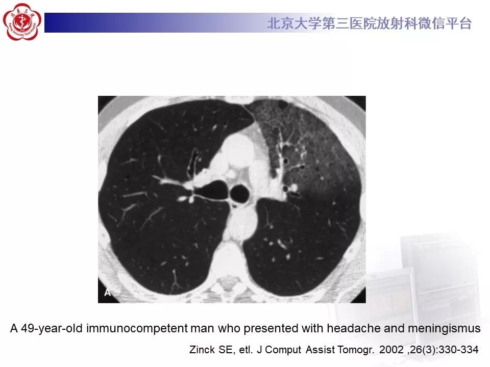 【病例】肺隐球菌病1例CT影像