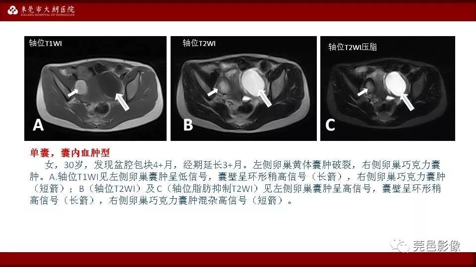 【PPT】MRI诊断卵巢黄体囊肿破裂