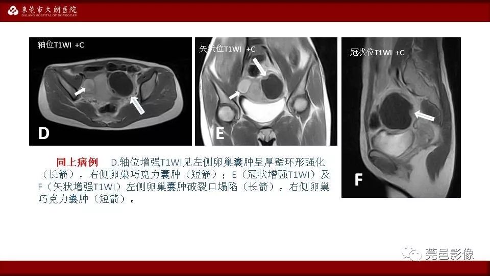 【PPT】MRI诊断卵巢黄体囊肿破裂