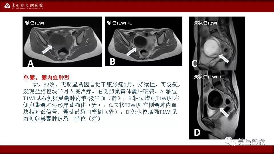 【PPT】MRI诊断卵巢黄体囊肿破裂