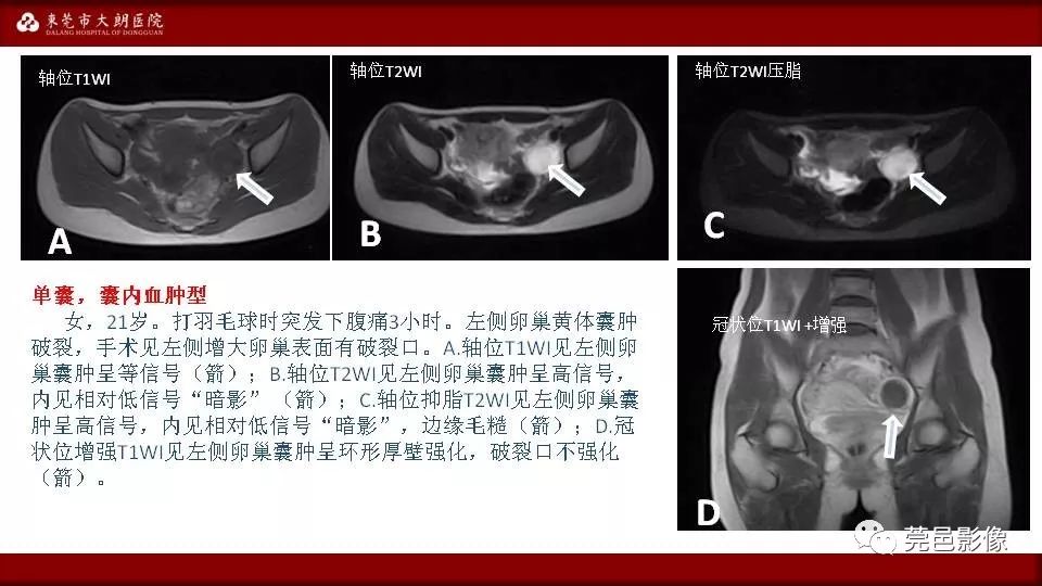【PPT】MRI诊断卵巢黄体囊肿破裂